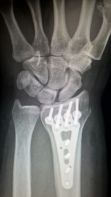 手臂骨折 钢板内固定术 钛板 - 上的免费照片