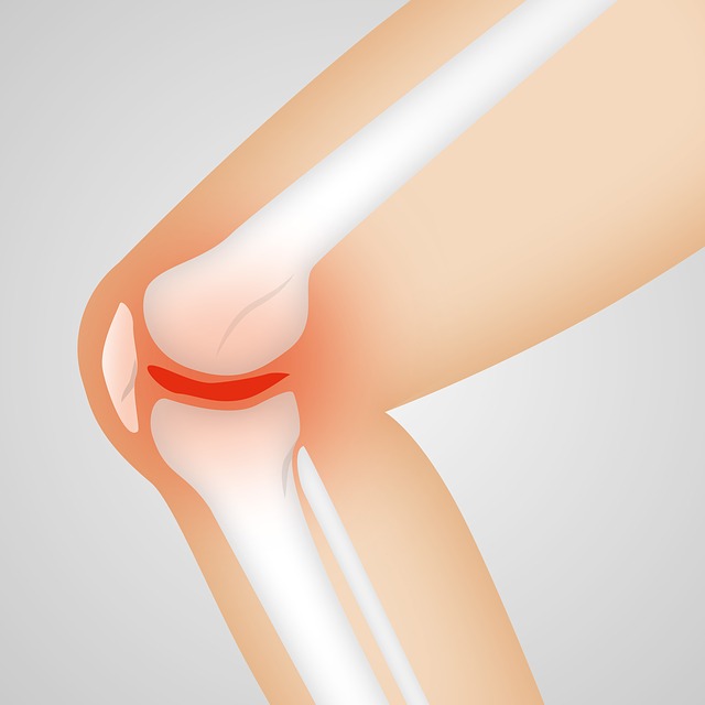 Arthrocalman 骨关节炎 - 上的免费图片