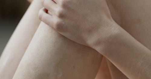 白癜风引起的女性皮肤变色 · 免费素材视频